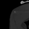 SPORK, NICO - 22.03.1976 - 02.08.2022 - CT obere Extremität - 17:59:07